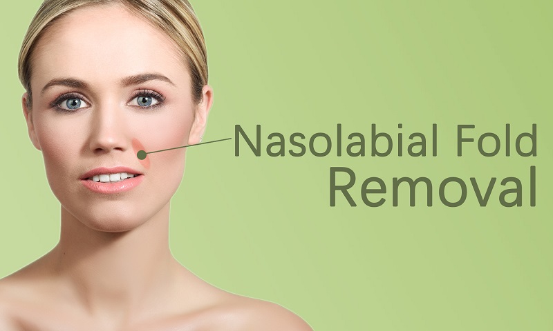 Nasolabial Fold Removal in Surat