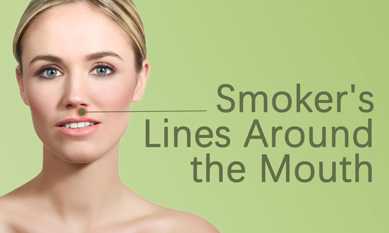 smoker-s-lines-around-the-mouth-treatment-in-surat-elegance-clinic